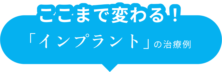 ここまで変わる！「インプラント」の治療例