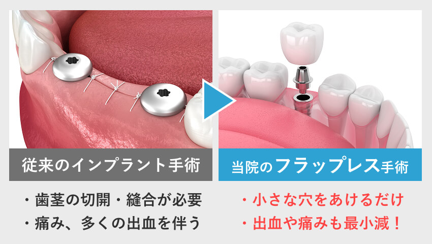 従来のインプラント手術　当院のフラップレス手術
